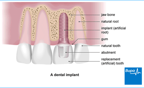 Dental implant diagram A diagram showing the workings of dental implants