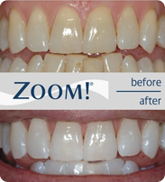 Zoom Whitening – Before and After