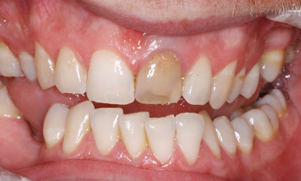 discoloured tooth Blue Light Dental