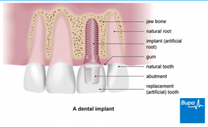 Dental Implants in Archway