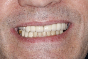 A smile after dental implants in north london