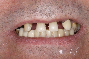 A smile before dental implants in north london