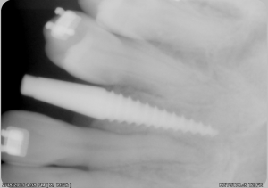 An xray of dental implants in north london