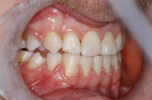 Teeth before 6 month smiles in north london