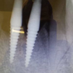 An image of the dental implants from our Crouch End dentists