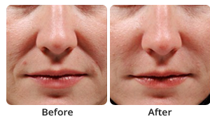 The before and after results of dermal fillers