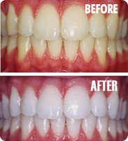 before and after examples of teeth whitening in North London