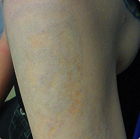 The skin after multi-colour laser tattoo removal in north london