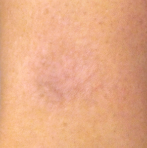 The skin after the laser tattoo removal in north london