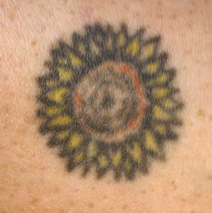 A tattoo before laser tattoo removal in North London