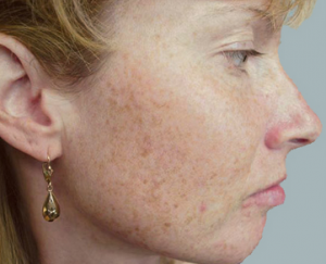 A woman with pigmented lesions to be removed