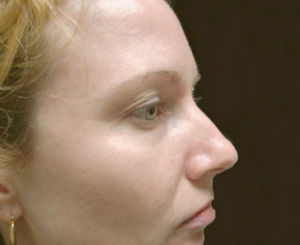 A woman with smooth skin after have lesion removal in north london