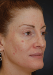 A woman after pigmented lesion treatment in north london