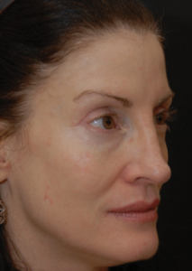 A woman with vascular and pigmented lesions removed in north london
