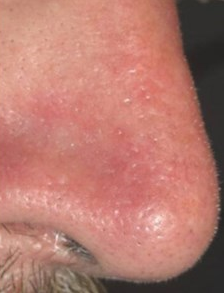 A nose after treatment for vascular lesions