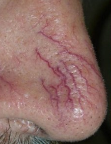 A nose with vascular lesions that can be treated at blue light dental clinic