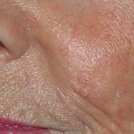 the skin after vascular lesions treatment at Blue Light Dental clinic