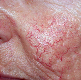 A close up of vascular lesions that we treat at blue light dentists in north london