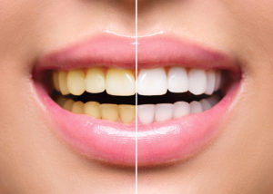 Woman smiling before and after teeth whitening