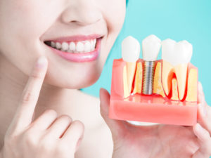 A woman with white teeth holding a model of some dental implants