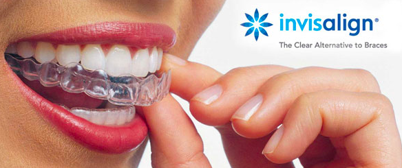 Invisalign Clear Braces System in Archway