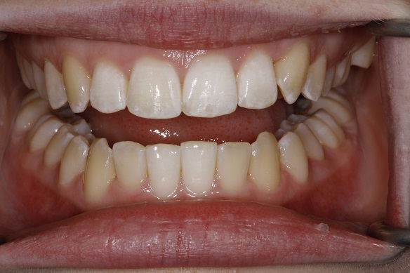 Invisalign – after treatment