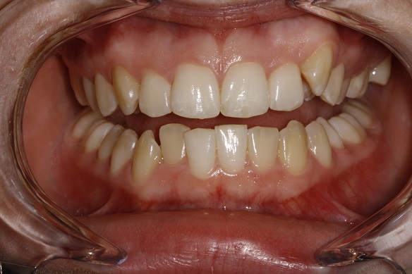 Invisalign – before treatment