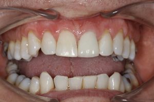 Teeth After Crowns