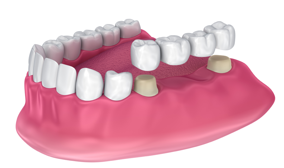 Dental Bridge Archway