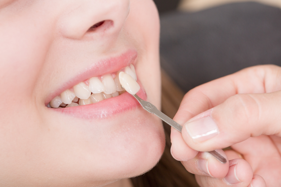 Image of another dental crown example. blue light dental clinic