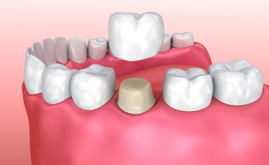 Dental Crowns Archway