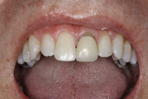 image showing tooth crown before treatment