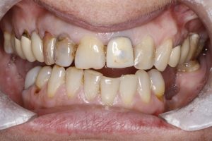 Dental Crown - Before Treatment