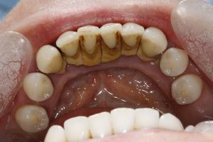 Tartar – after treatment