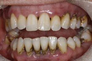 Tartar – before treatment