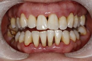 Tartar – after treatment