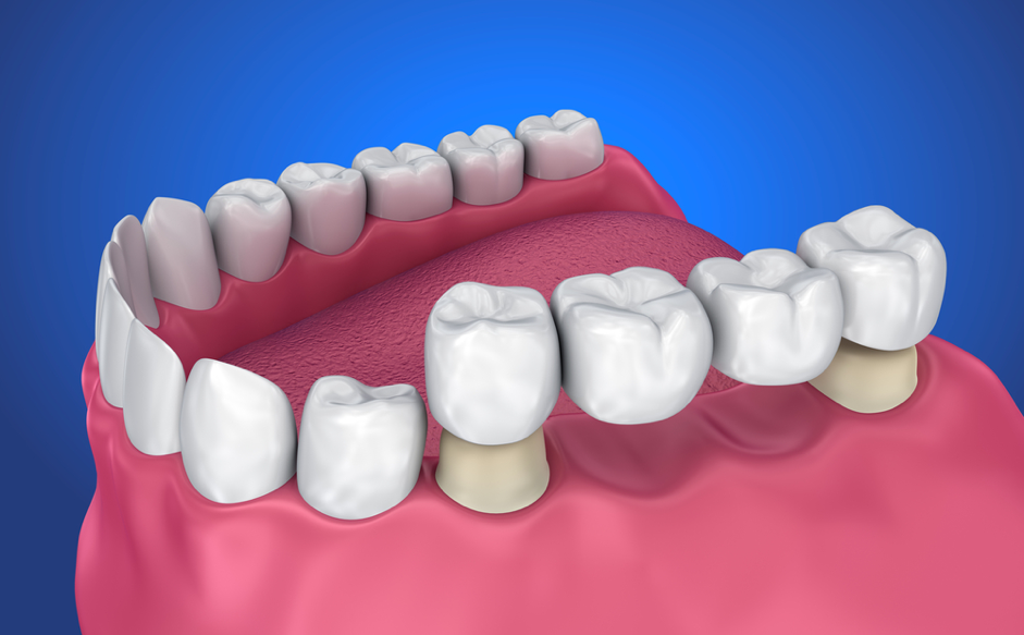 Visual depiction: Dental bridge example for comparison.