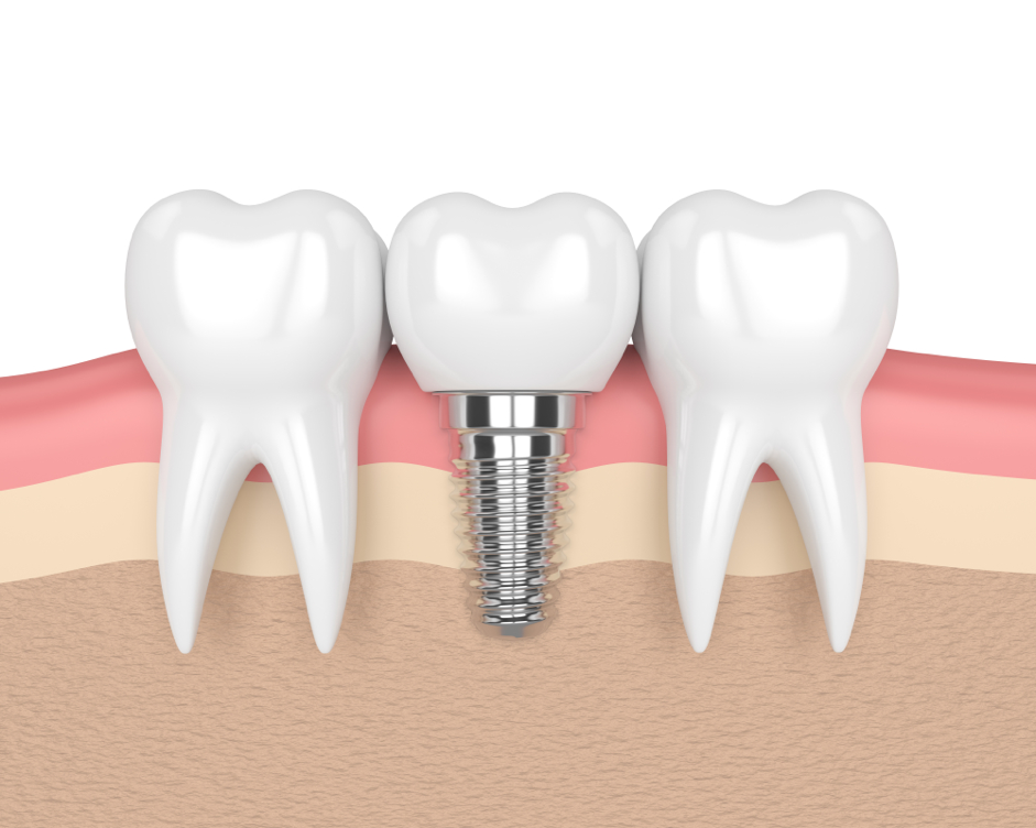 Image of a dental implant for illustration