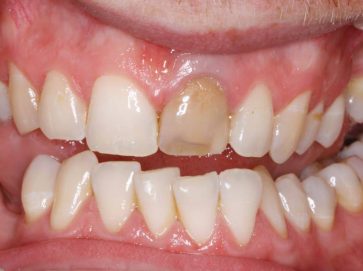 Blue Light Dental - Before