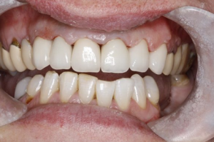 Dental Crown - After Treatment