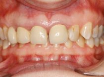 Blue Light Dental - Before