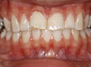 Blue Light Dental - Before