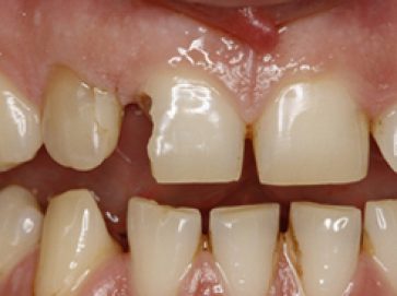 Blue Light Dental - Before