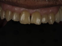 chipped tooth