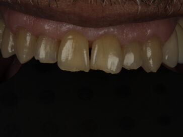 chipped tooth